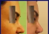 جراحی بینی گوشتی (پوست ضخیم)