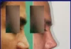 جراحی بینی ترمیمی